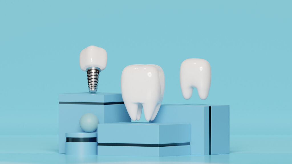 The Complete Guide to Dental Implants: Benefits, Process, and Recovery