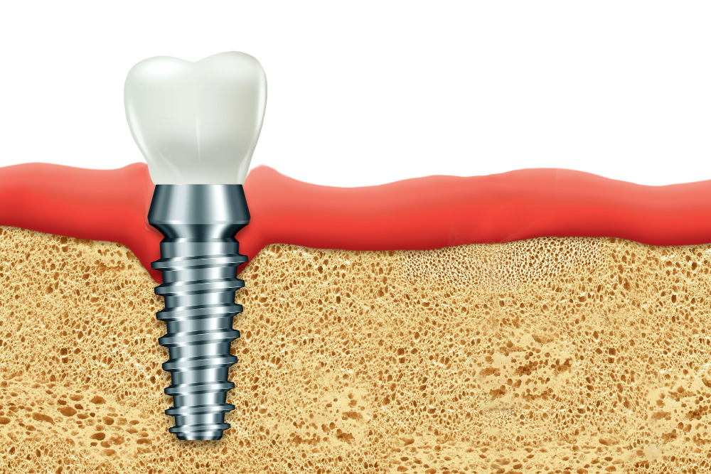 The Benefits of Root Teeth Implants Over Traditional Dentures