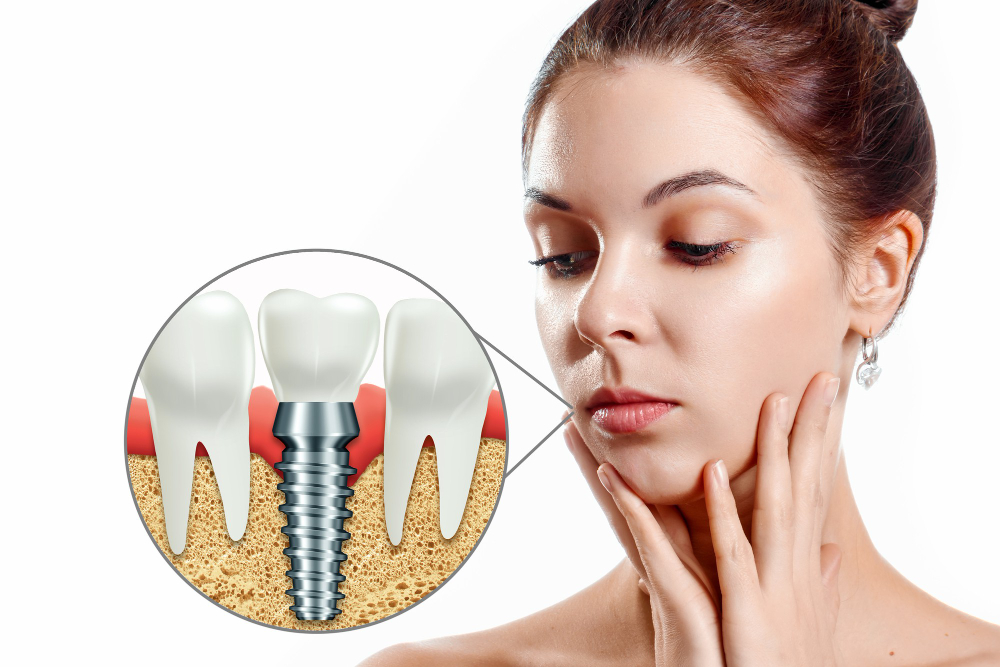 The Step-by-Step Process of Getting Root Teeth Implants