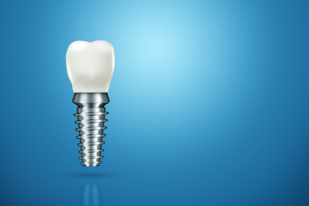 The Dental Implant Process: What to Expect from Consultation to Recovery