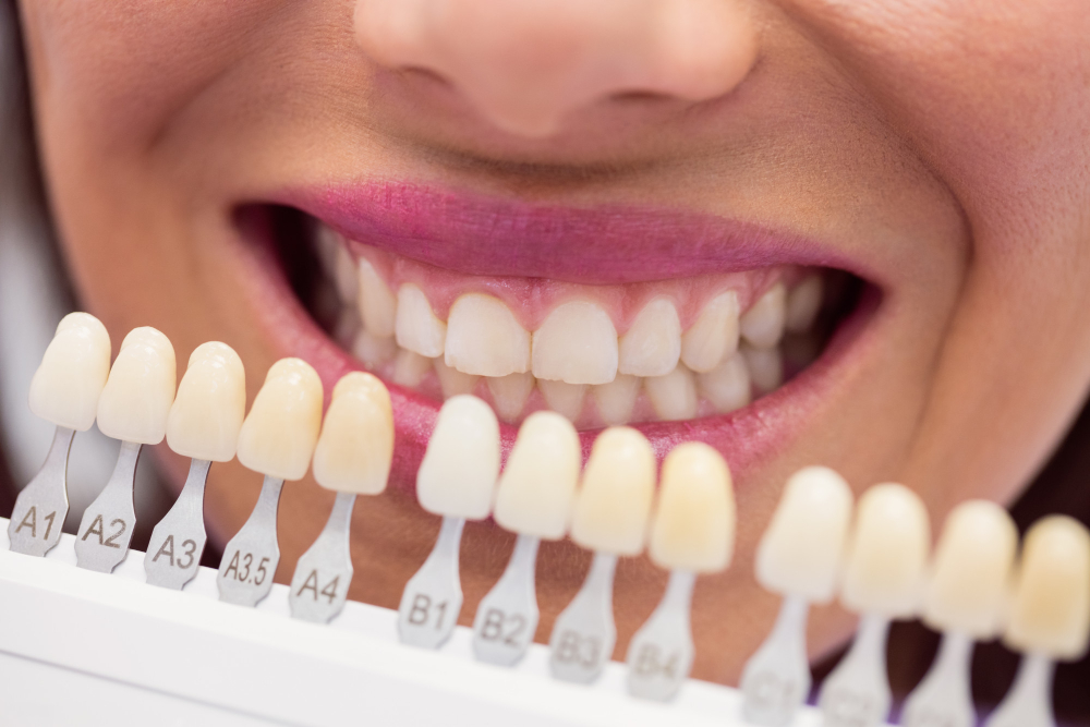 Natural vs. Chemical Teeth Whitening: Which Option Is Best for Your Smile?